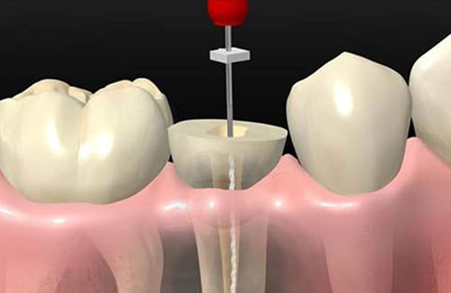 root canal treatment