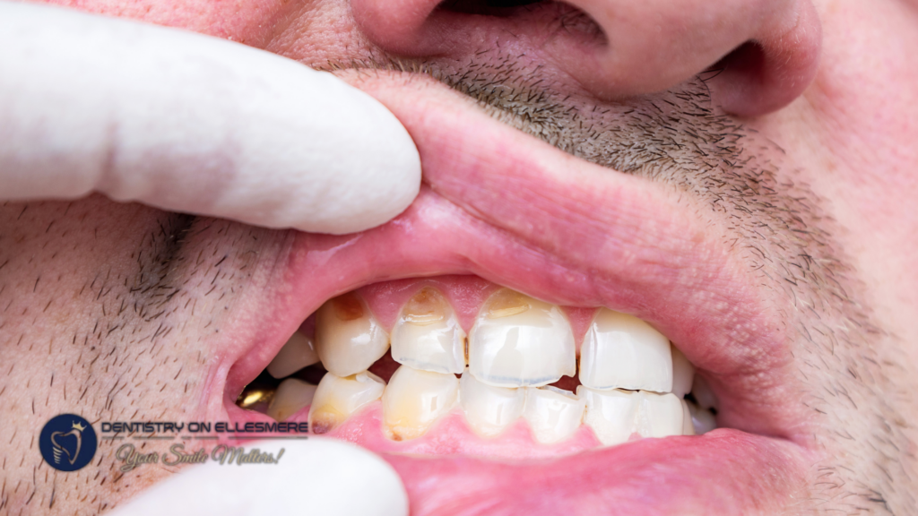 Cosmetic Bonding_ A Quick Fix for Chipped Teeth
