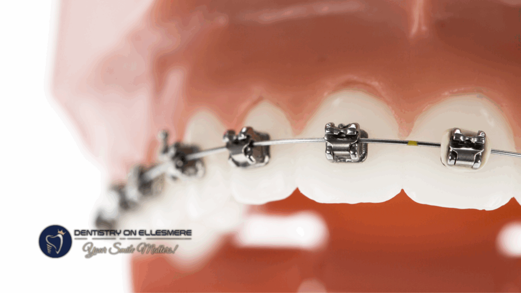 The Role of Orthodontics in Reducing Dental Crowding