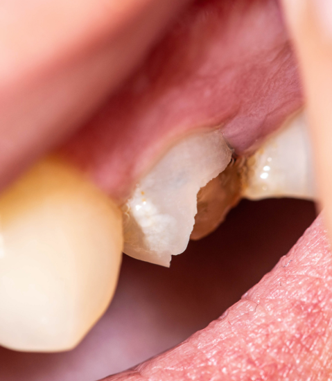 Broken or Chipped Tooth Scarborough