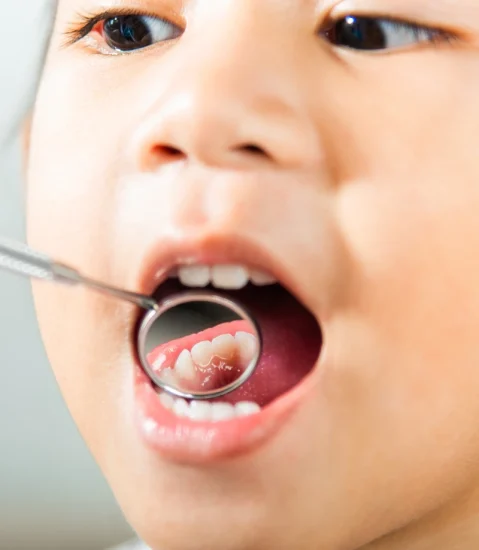 Cavities Treatment
