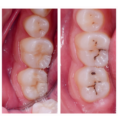Composite Bonding