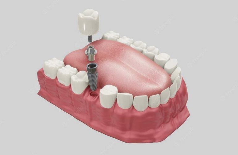 Dental Implants